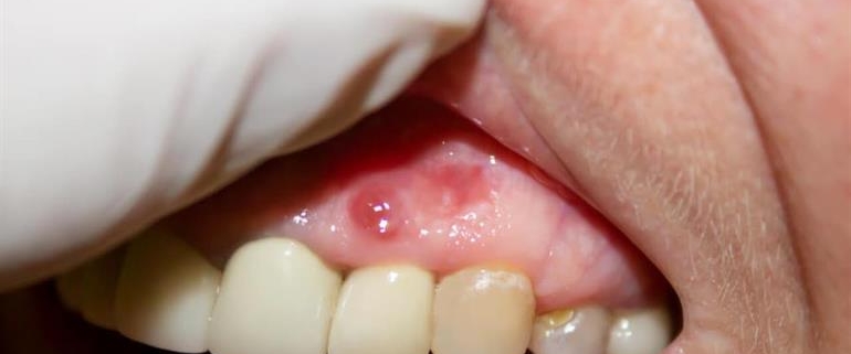 عفونت‌های لثه و روش‌های درمانی آن