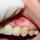 عفونت‌های لثه و روش‌های درمانی آن