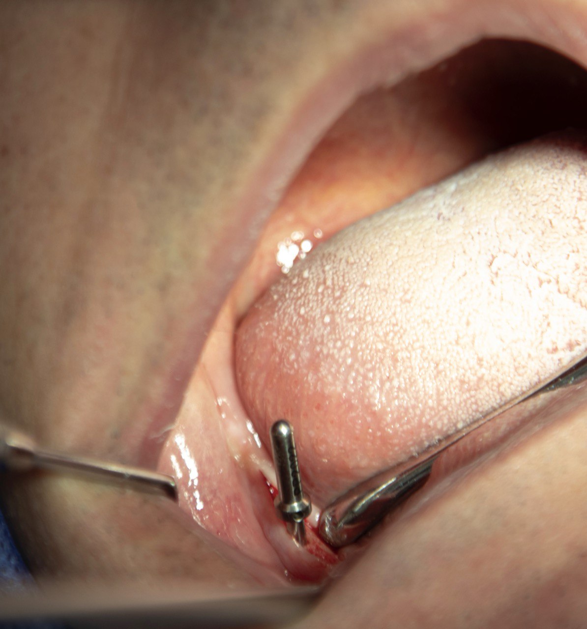 جراحی پیوند استخوان