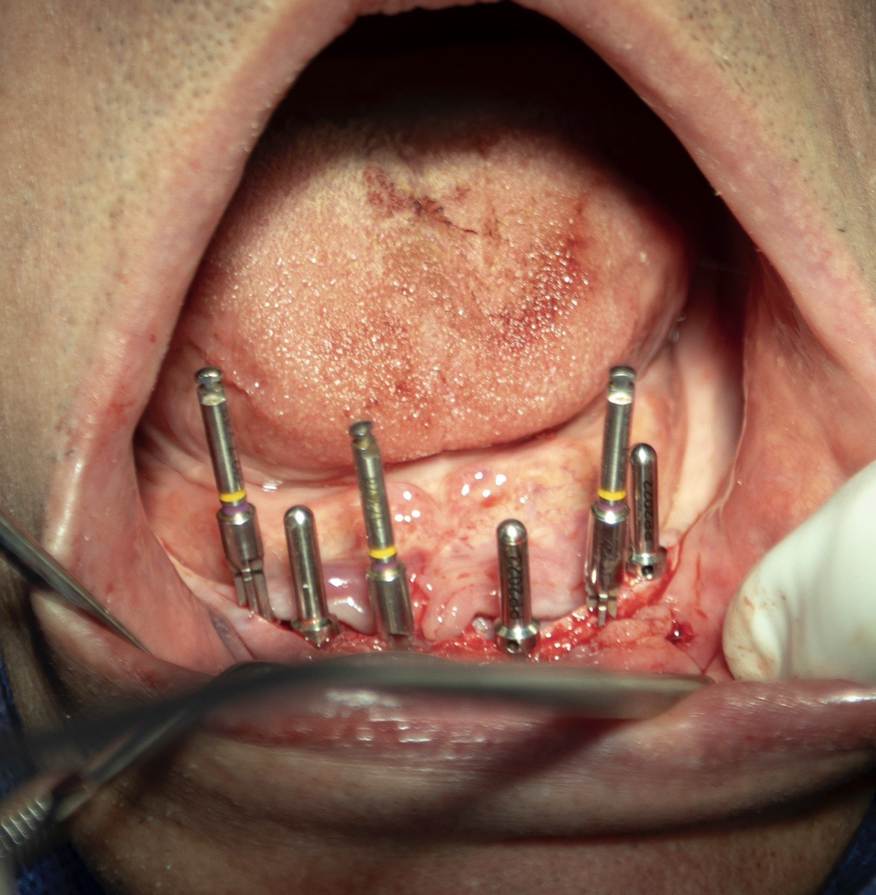 جراحی ایمپلنت دندانی